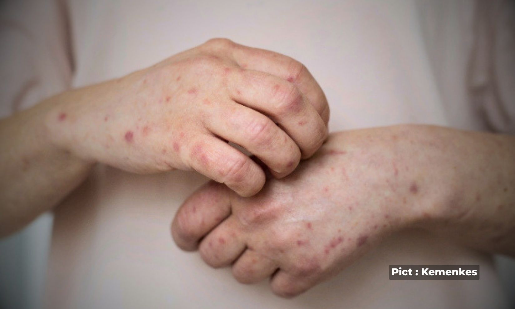 melihat-fenomena-peningkatan-kasus-campak-di-jawa-tengah-yuk-kenali-gejalanya-dan-pencegahannya